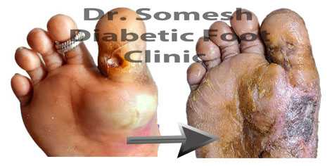 Diabetic Gangrene Stages Great Toe Base Podiatry Doctor