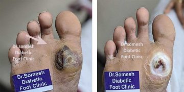 Diabetes Foot Gangrene Stages St Metatarsal Head Region Podiatry Doctor