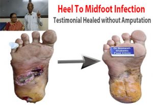 Foot Infection
