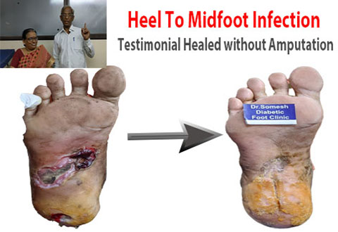 Foot Infection