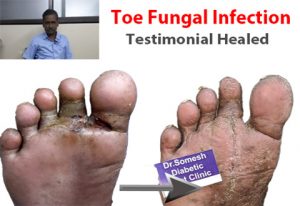 Toe Fungal Infection
