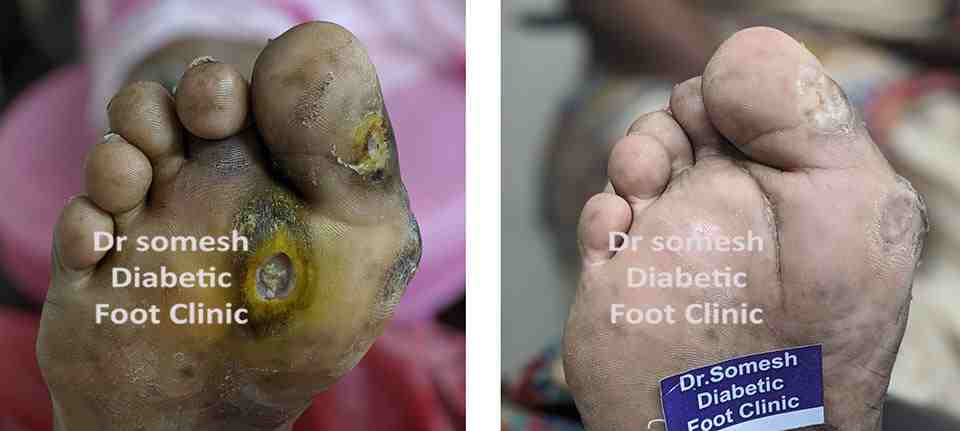 dr somesh diabetic foot clinic 444
