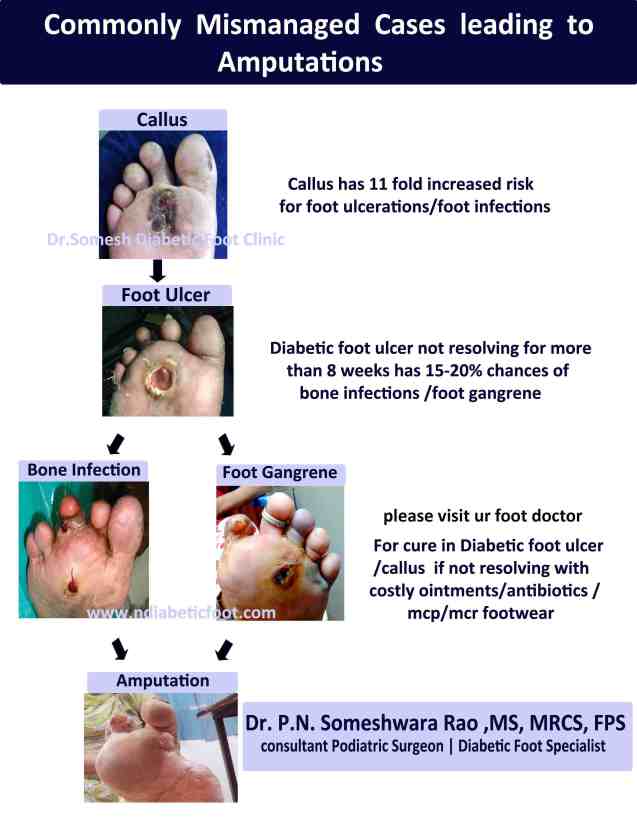 Diabetic Foot Ulcer Stages 2nd Mtp Region Podiatry Doctor