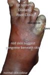 Diabetic Gangrene Foot