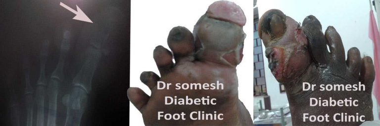 Diabetic Foot Gangrene Stages Great Toe Tip Podiatry Doctor