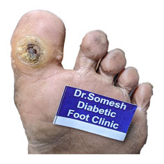 Diabetic Gangrene stages-Great Toe Base - Podiatry Doctor