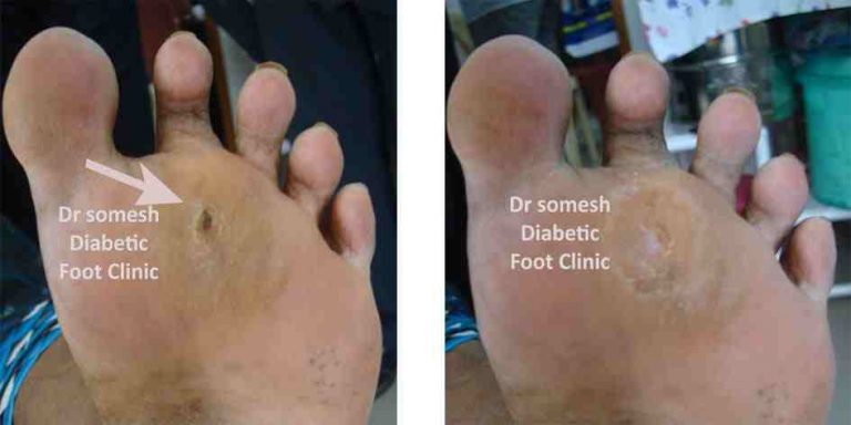 Diabetic Foot Ulcer Stages 2nd MTP region - Podiatry Doctor