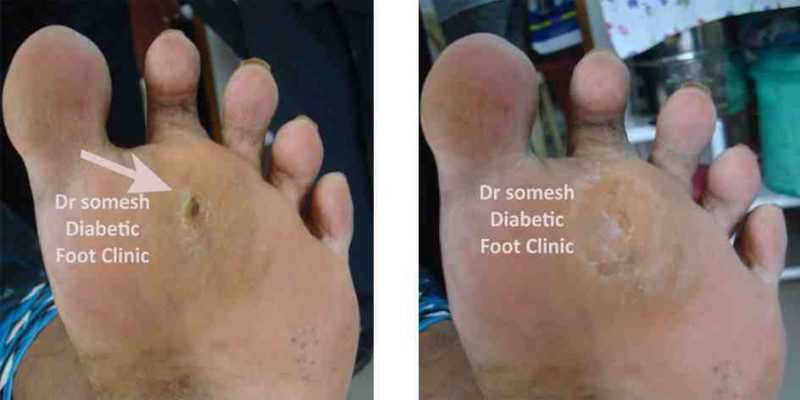 Diabetic Foot Ulcer Stages 2nd Mtp Region Podiatry Doctor