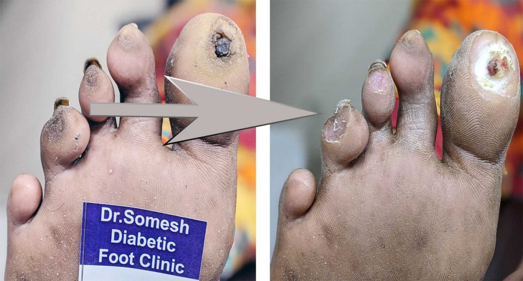 Diabetic Foot Gangrene stages Great Toe Tip - Podiatry Doctor