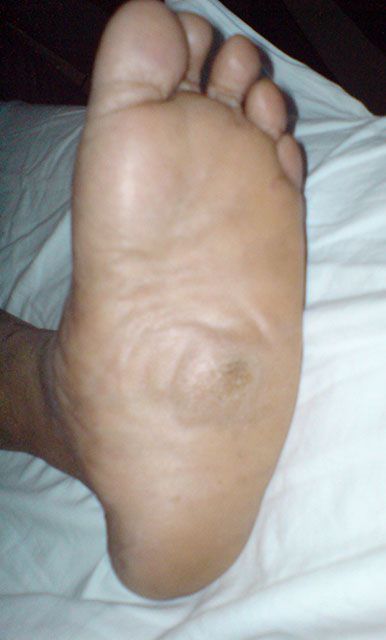 charcot foot callus
