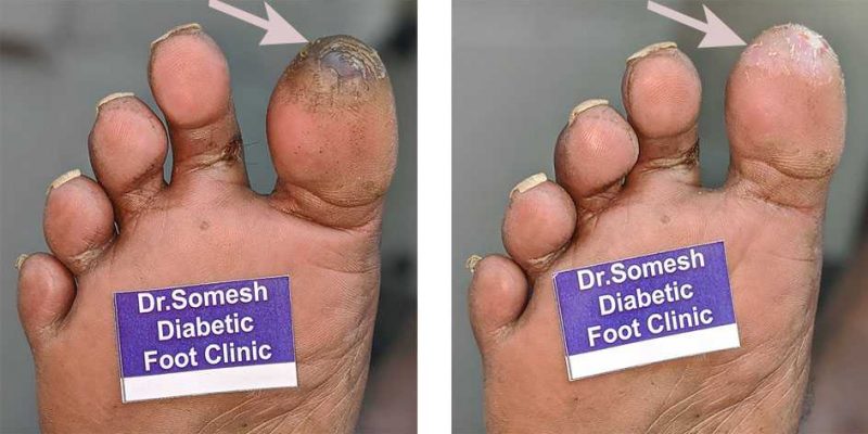 diabetic-foot-gangrene-stages-great-toe-tip-podiatry-doctor