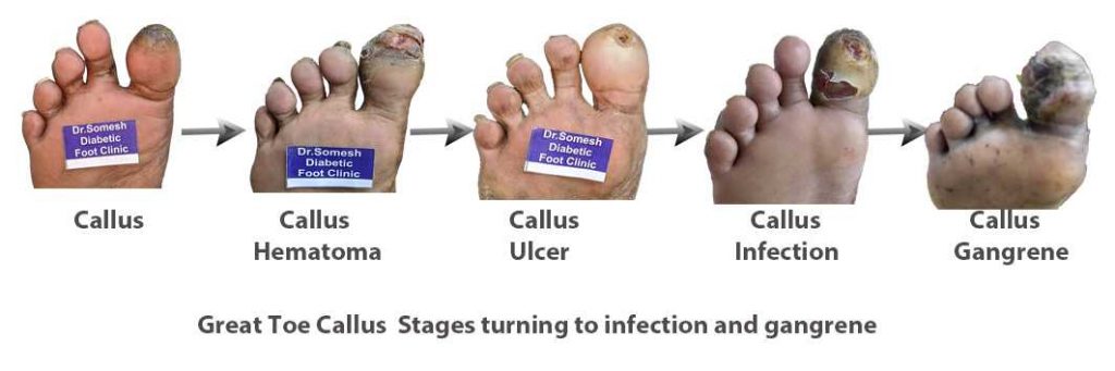 Diabetic Foot Gangrene Stages Great Toe Tip - Podiatry Doctor