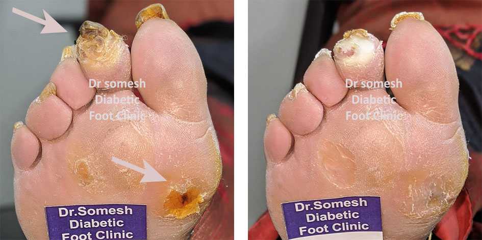 Diabetes Foot Gangrene stages 1st Metatarsal head region - Podiatry Doctor