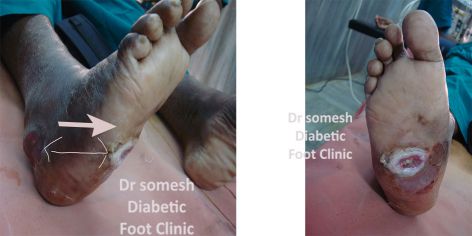 charcot foot infection