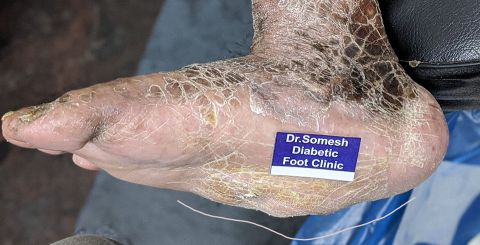 charcot foot deformity