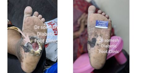 Charcot foot ulcer