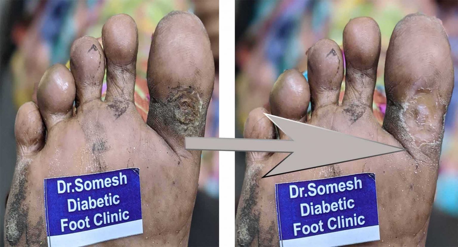 Diabetic Gangrene stagesGreat Toe Base Podiatry Doctor