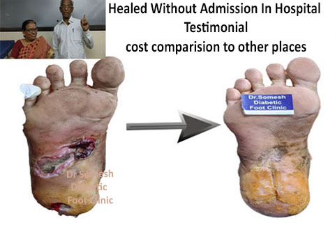 heel ulcer turned gangrene foot