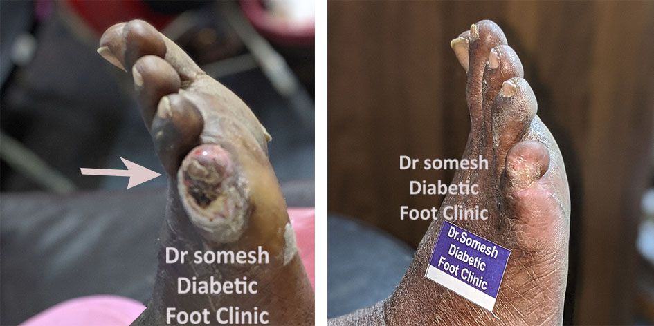 little toe gangrene dr somesh podiatrist