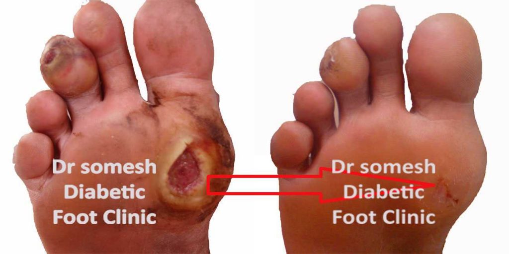 Diabetes Foot Gangrene Stages 1st Metatarsal Head Region Podiatry Doctor 2279