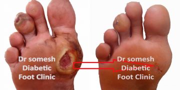 Diabetes Foot Gangrene Stages St Metatarsal Head Region Podiatry Doctor