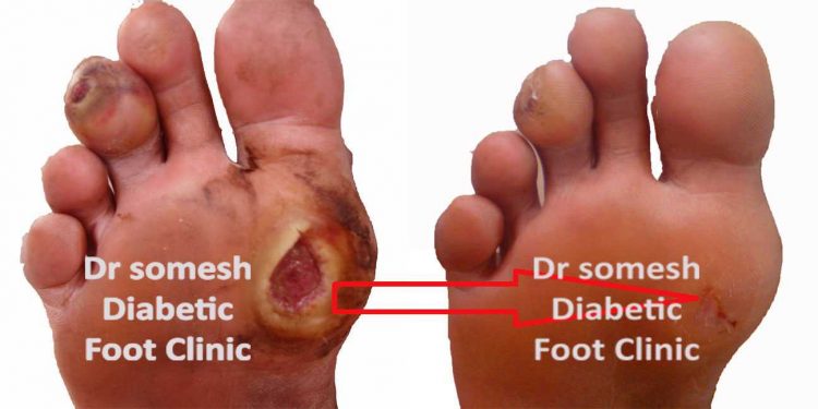 Diabetes Foot Gangrene stages 1st Metatarsal head region - Podiatry Doctor