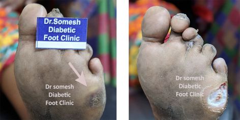 dr somesh diabetic foot clinic 4444
