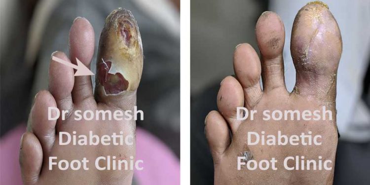 Diabetic Foot Gangrene stages Great Toe Tip - Podiatry Doctor