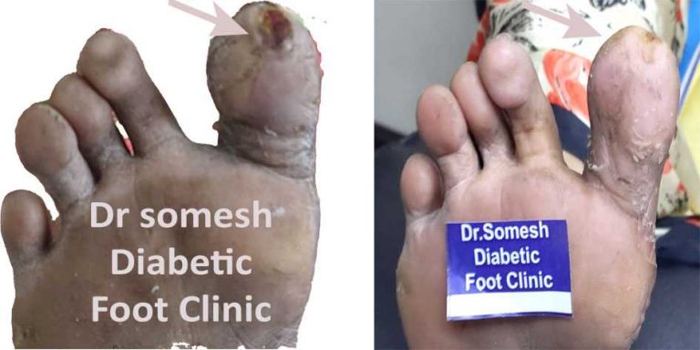 Diabetic Foot Gangrene Stages Great Toe Tip - Podiatry Doctor