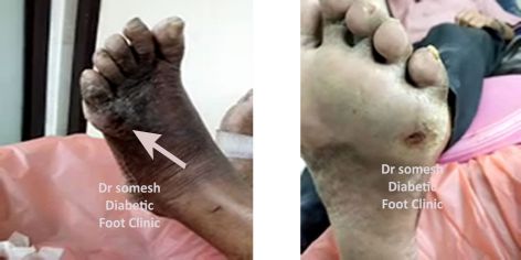dr somesh diabetic foot clinic 4414