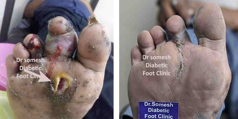 dr somesh diabetic foot clinic 447