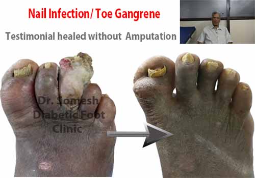 Diabetes gangrene leg amputation