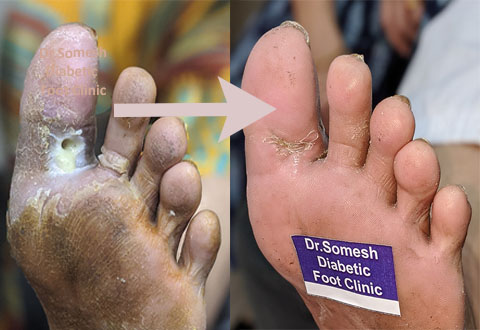toe infections