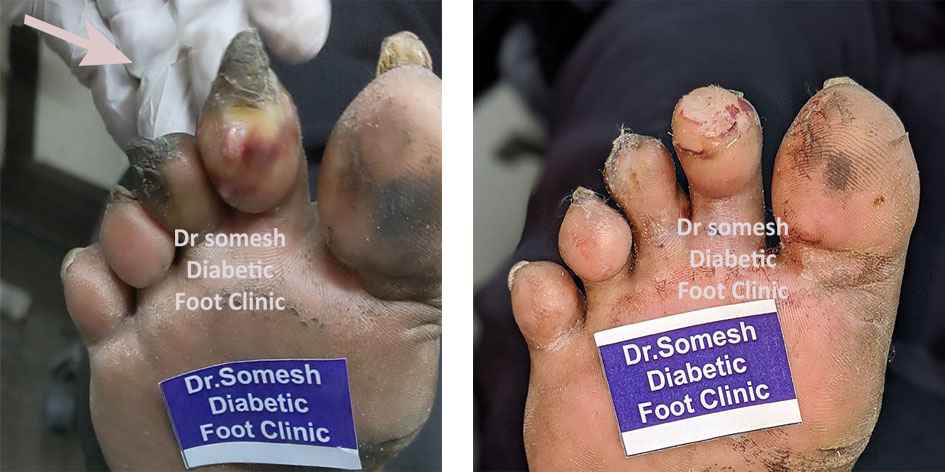 Diabetic Gangrene stages-Long toe, Middle toe, Ring toe - Podiatry Doctor