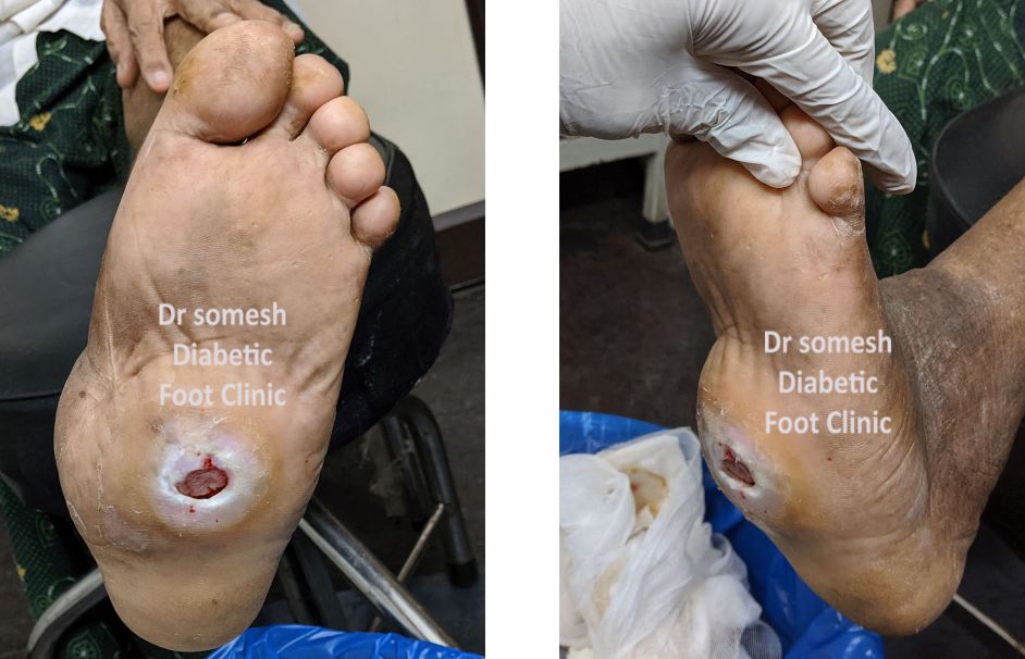 charcot foot ulcer 3