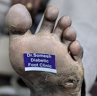 drsomesh diabetic foot clinic 441