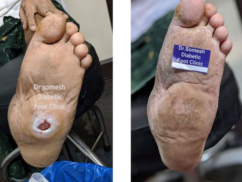 charcot foot ulcer 4