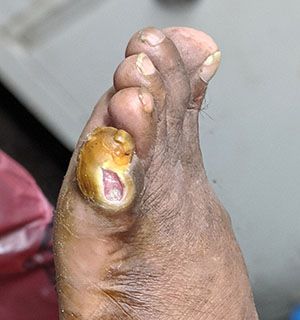 little toe ulcer dr somesh podiatrist