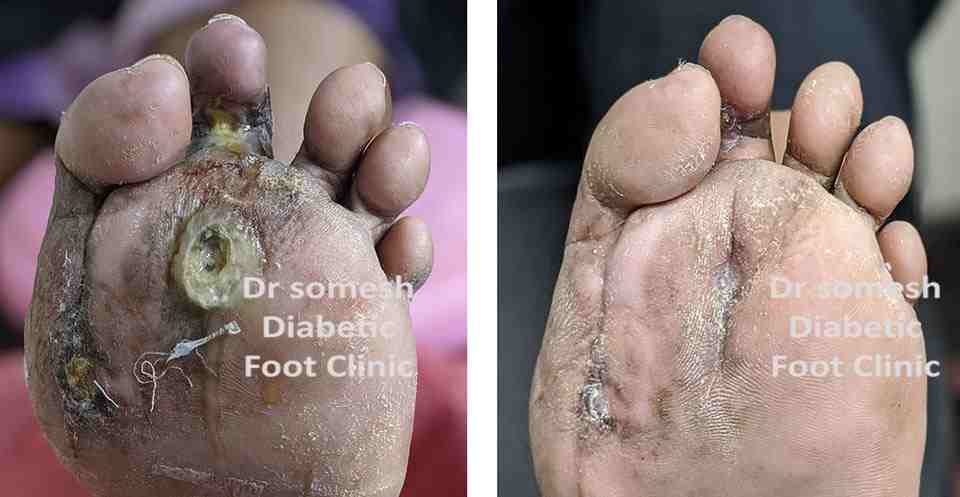 dr somesh diabetic foot clinic 446