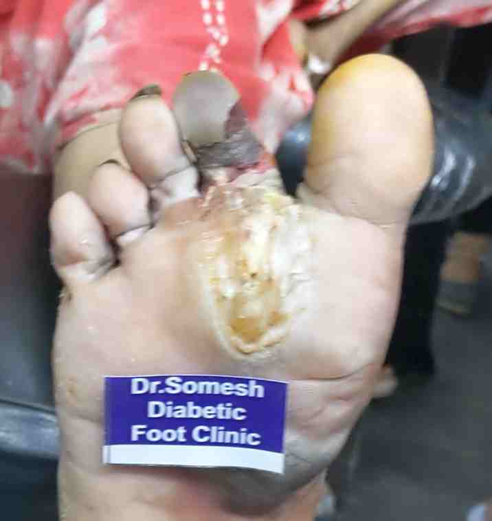 dr somesh diabetic foot clinic 448