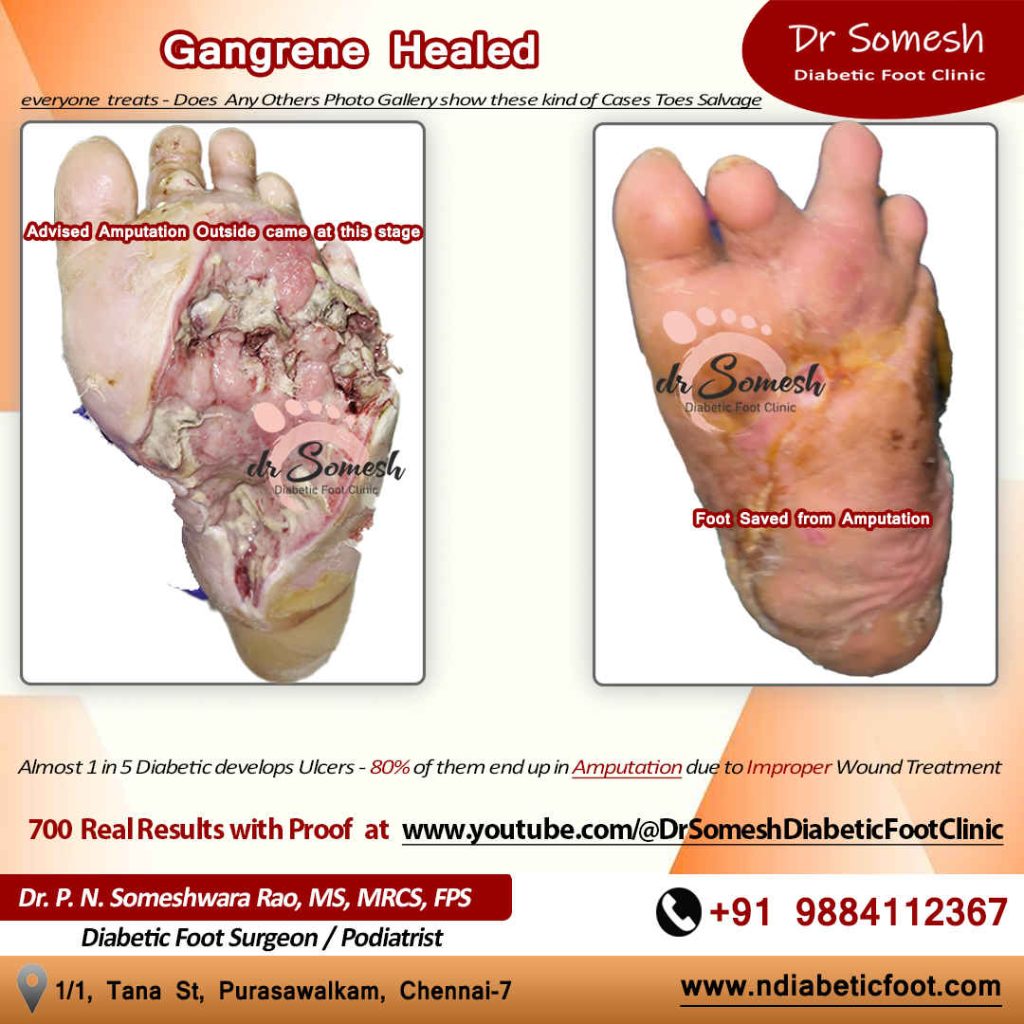 podiatrist chennai | diabetic foot clinic