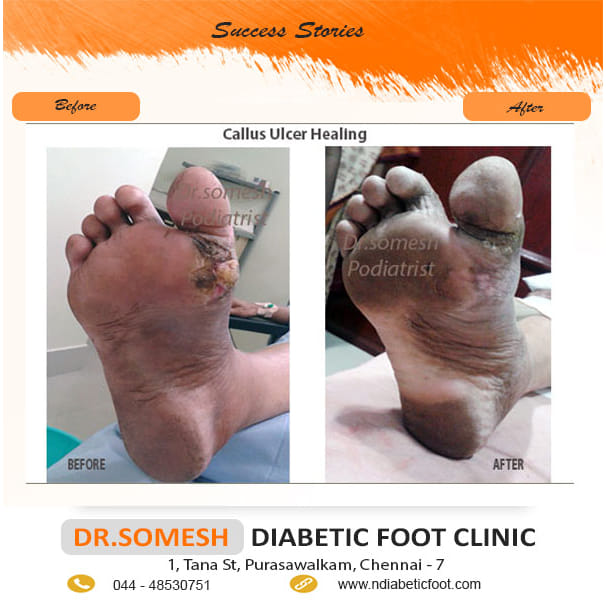 podiatrist chennai | diabetic foot clinic