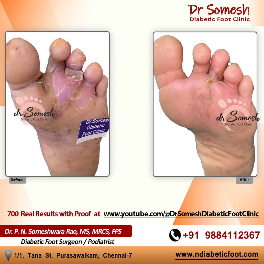 podiatrist chennai | diabetic foot clinic