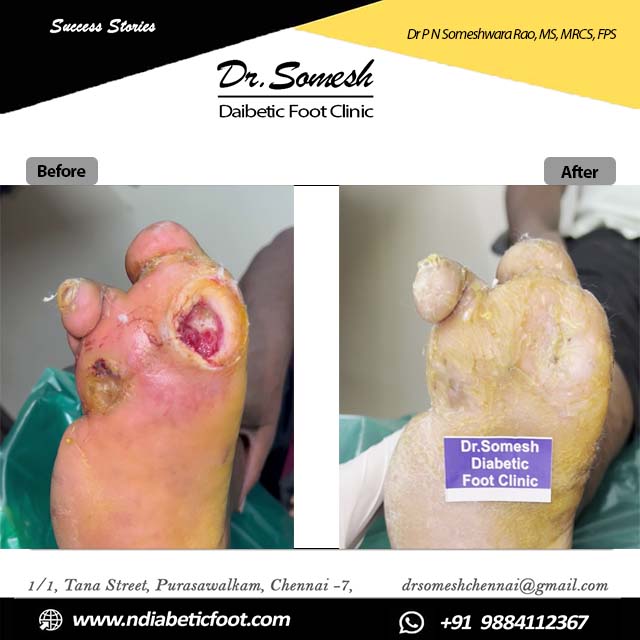 podiatrist chennai | diabetic foot clinic