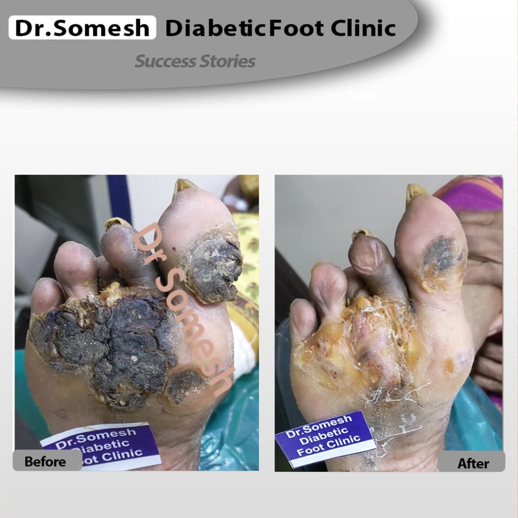 podiatrist chennai | diabetic foot clinic