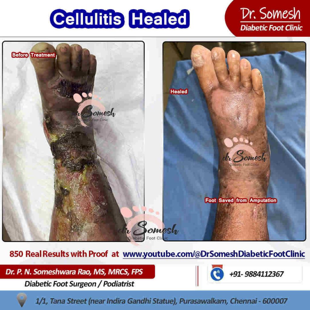 podiatrist chennai | cellulitis infection