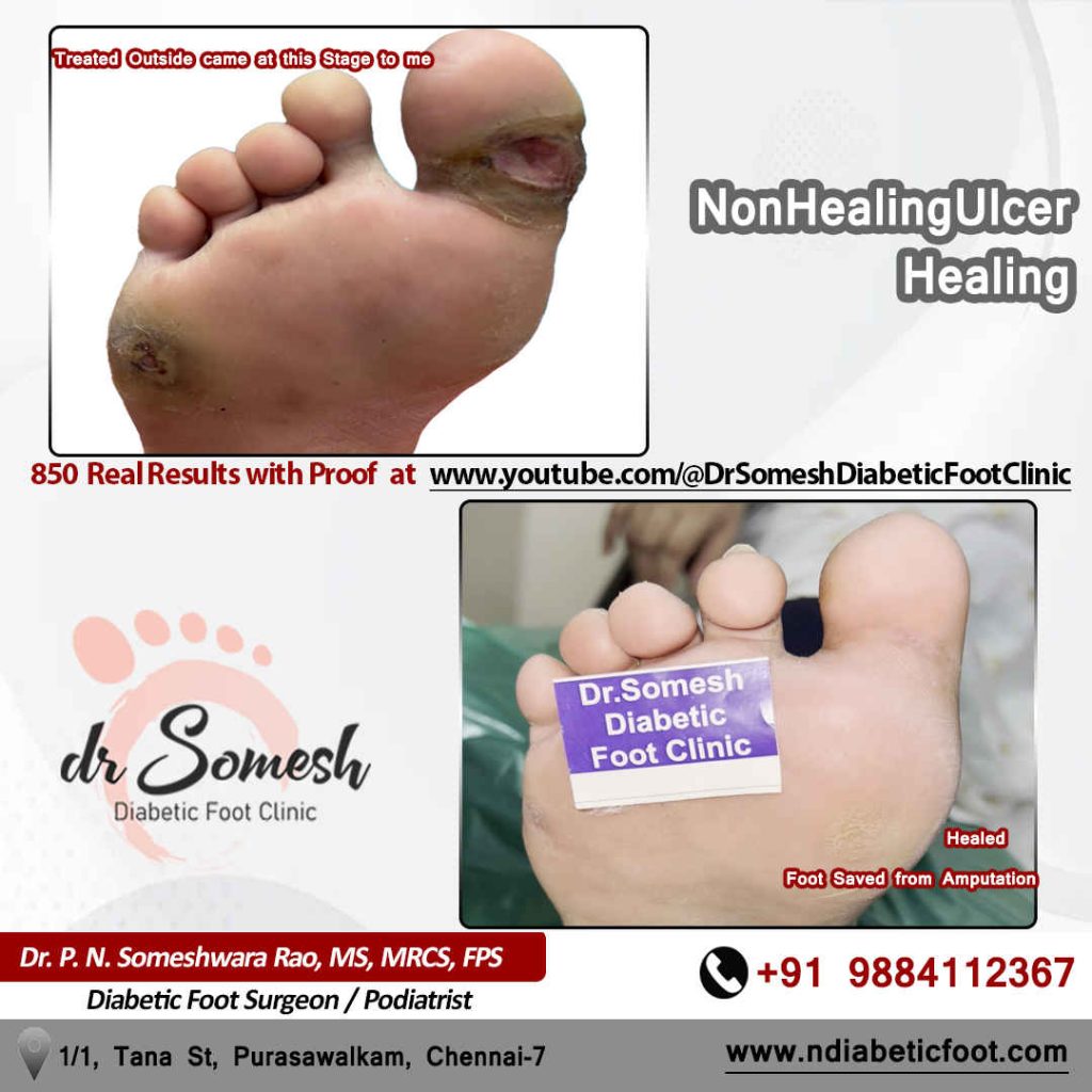 podiatrist chennai | diabetic foot clinic
