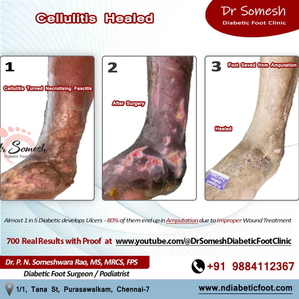 podiatrist chennai | diabetic foot clinic