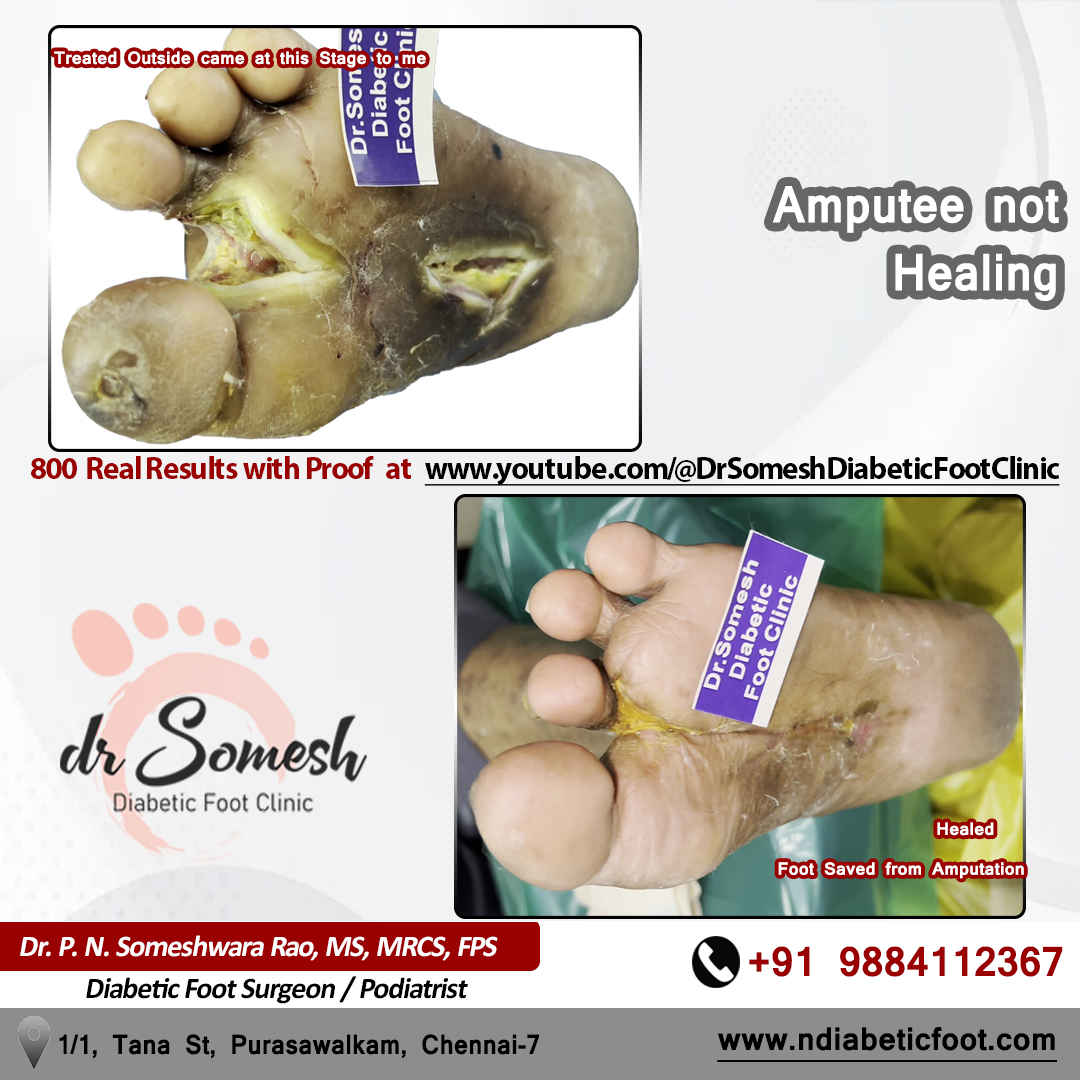 podiatrist chennai | diabetic foot clinic