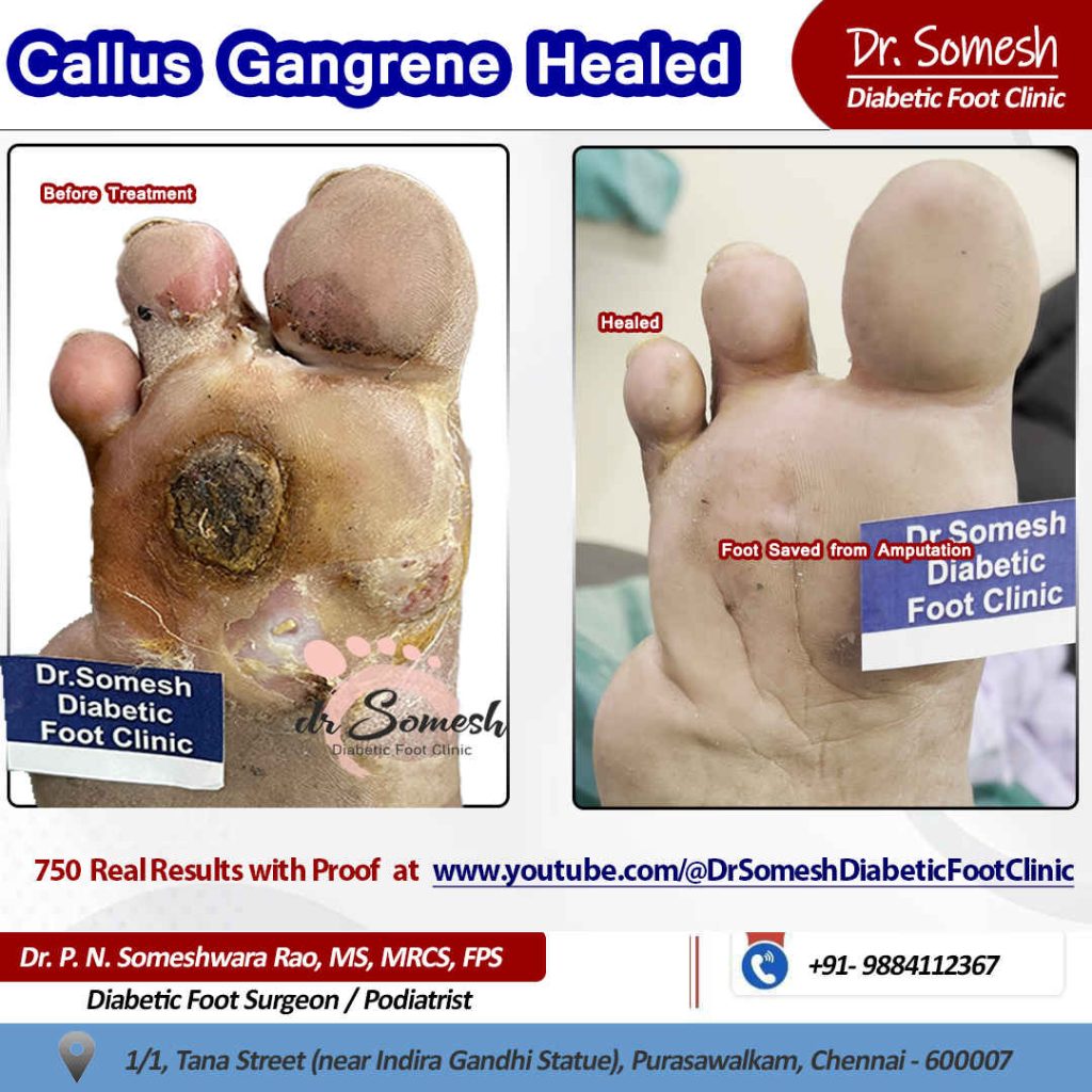 podiatrist chennai | diabetic foot clinic